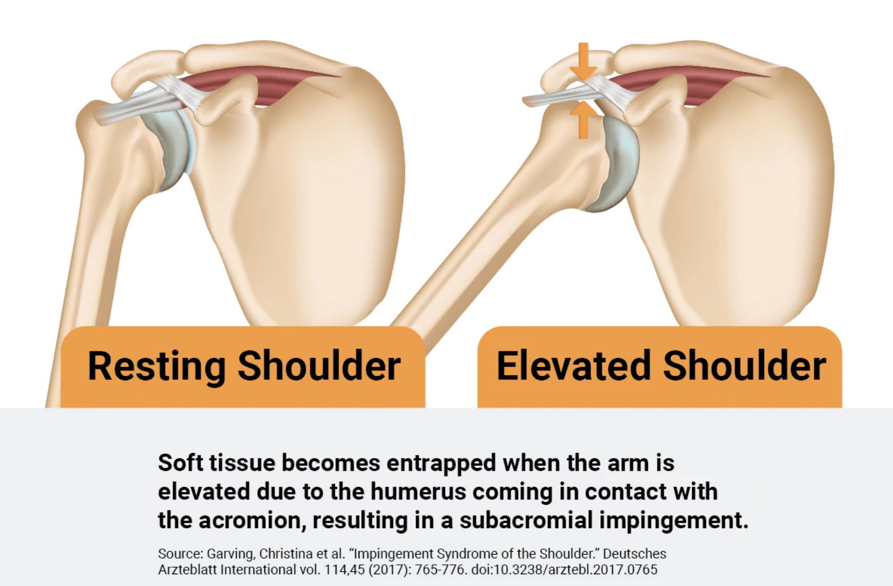 Shoulder Pain Impinging On Your Life